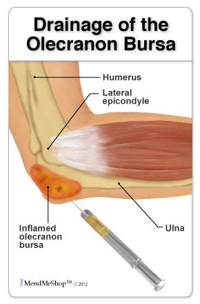 Bursa Surgeries