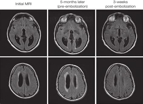 Axial FlAIr MrI performed at the time of presentation to medical ...