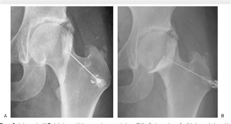 [PDF] MR and CT Arthrography of the Hip Llopis | Semantic Scholar