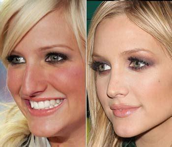 Ashlee Simpson Plastic Surgery Before And After Nose Job Photos