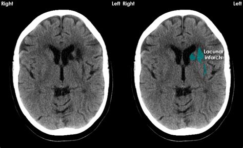 Lacunar Stroke