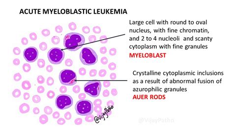 Peripheral smear findings in Leukemia – Illustrated | Pathology Made Simple