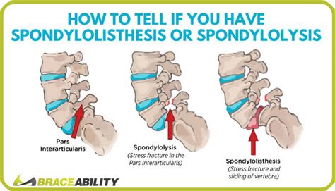 Do I Have Lumbar Spondylolisthesis or Spondylolysis?