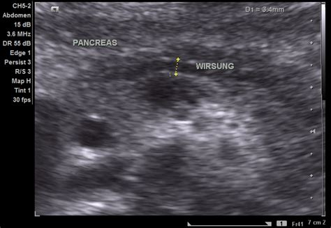 Pancreatic Duct Ultrasound