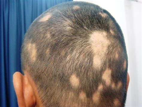 Cure Discovered for Hair Loss Due to Alopecia – Guardian Liberty Voice