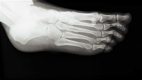 5th Metatarsal Fracture | Jones Fracture | Dancers Foot Fracture