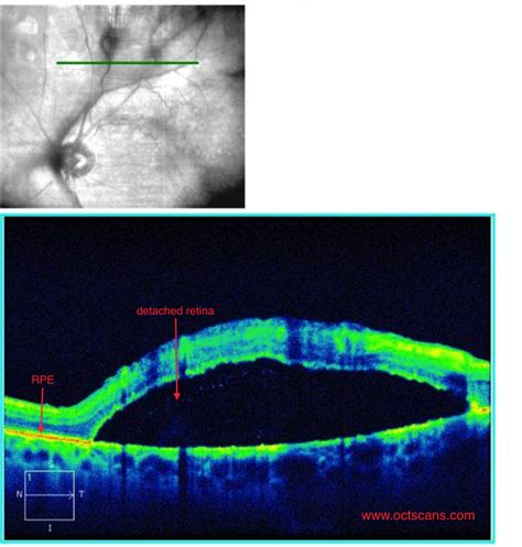 Retinal Detachment - Optical Coherence Tomography Scans