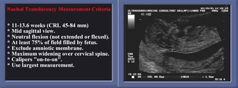 Nuchal Translucency Chart Measurements