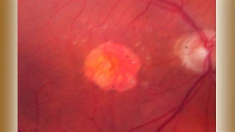 AMD and Retinal Disease | Medscape