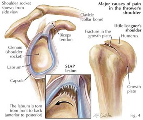 Diagram Of Shoulder Labrum / glenoid-labrum-capsule-and-cuff - Shoulder ...