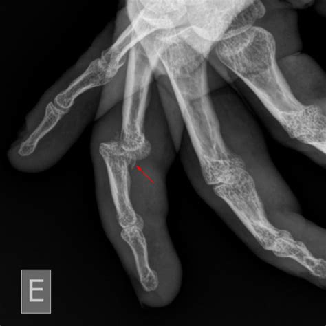 volar plate avulsion injury | pacs