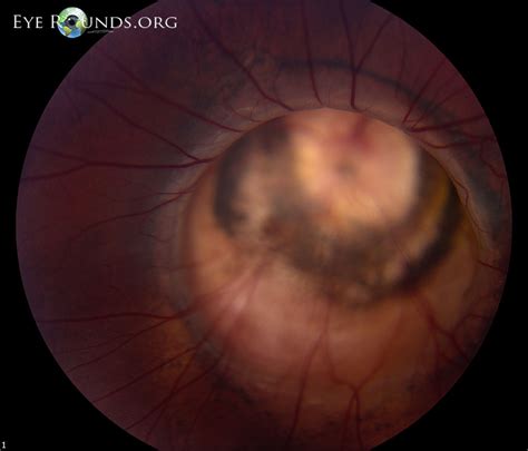 Atlas Entry - Morning Glory Disc Anomaly with Peripapillary Staphyloma