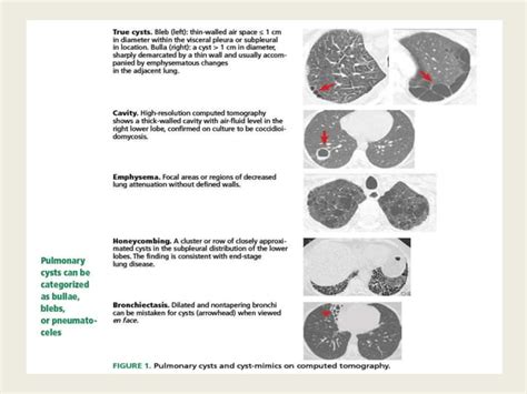 Cystic lung disease; Stepwise approach to diagnosis