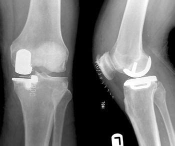 Partial Knee Replacement - Physiopedia