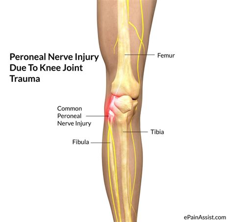 총비골신경 두 번째 이야기 그리고 원인대조 후 해결법 제시 (Common peroneal nerve history and ...