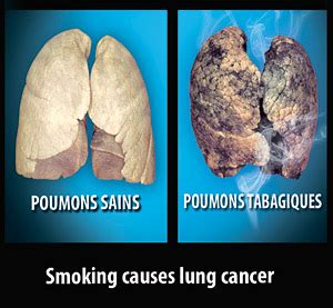 Smoking causes lung cancer - Mauritius