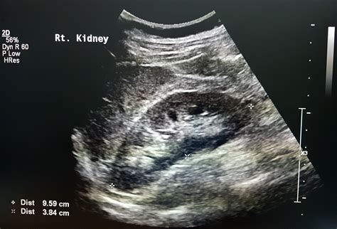 Kidney Stones Ultrasound