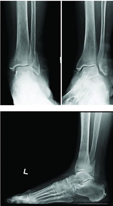 Early Weight-Bearing Following Ankle Fracture ORIF