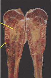 Ewing Sarcoma : Bone Tumor Cancer : Tumors of the Bone