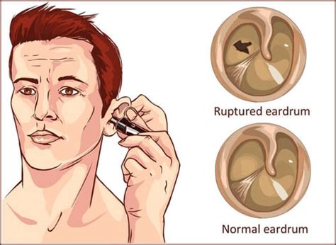 Tympanic Membrane Perforation: Symptoms, Causes, and Treatment Options