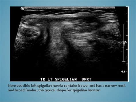 MEDICAL SCHOOL: MEDICAL ULTRASOUND/ HERNIA | Medical ultrasound ...