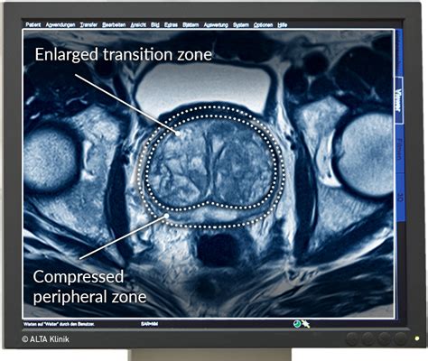 Mri Prostate Zones at allietsmitho blog