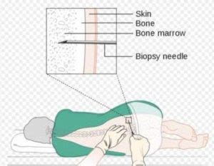 Bone Marrow Cancer | Health Recovery Tips