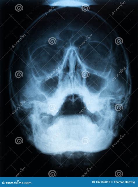 Sinusitis . Film X-ray Of Human Skull With Inflamed At Sinus Stock ...