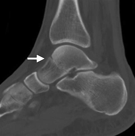 Talar Fractures and Dislocations: A Radiologist’s Guide to Timely ...