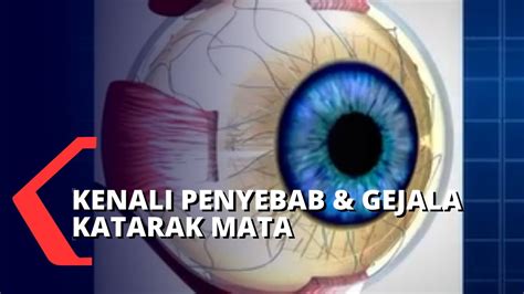 Apa Penyebab Katarak pada Mata? - YouTube