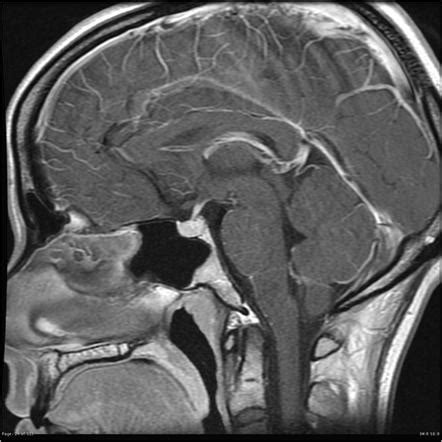 Pituitary Mri Brain Anatomy