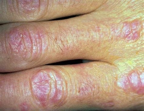 Dermatomyositis - Pictures, Symptoms, Treatment, Diagnosis, Causes ...