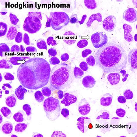 Hodgkin lymphoma - Blood Academy