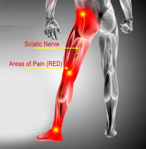 Sciatica Hip Pain Causes, Treatment Los Angeles, Beverly Hills, Santa ...