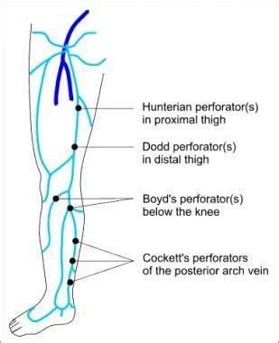 Varicose Vein Surgery: Practice Essentials, Anatomy, Pathophysiology