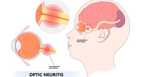 Optic neuritis symptoms & Treatment | Moorfields Eye Hospitals