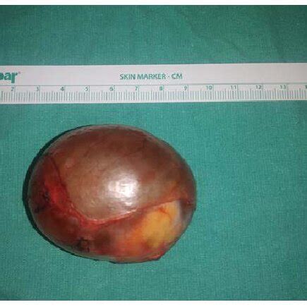 View of an ovarian dermoid cyst during ovary sparing surgery ...