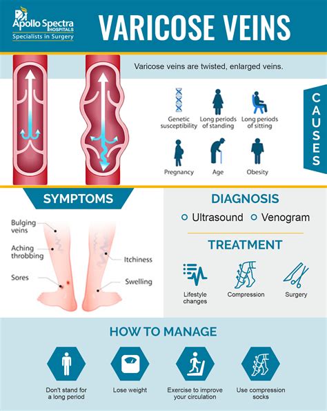 Varicose Veins Prevention