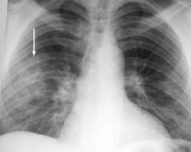 Crack lung: The acute syndrome hits headlines again