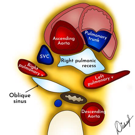 Pericardial recesses | Radiology Reference Article | Radiopaedia.org