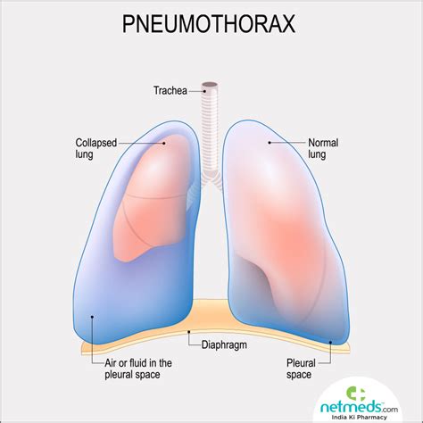 Pneumothorax Causes Signs Symptoms Treatment