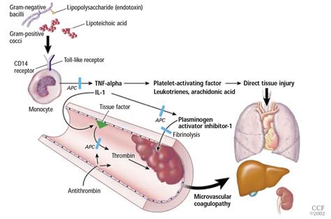 Disease Management: Sepsis