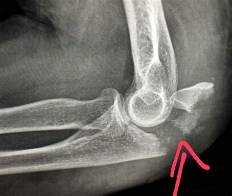 Olecranon Process Fracture