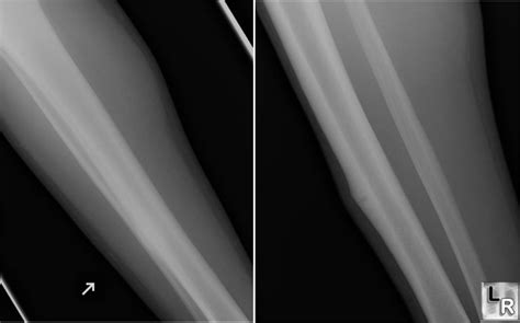 Stress Fracture X Ray Tibia