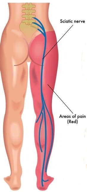 Bulging Disc L4-L5 – 2023 Guide to Symptoms & Treatment