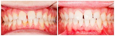 Plaque Removal stock photo. Image of treat, tartar, aesthetic - 35669016