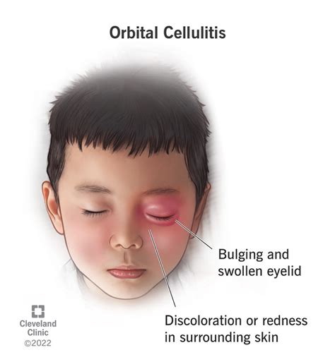 Periorbital Cellulitis Contagious