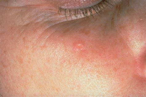 Skin Conditions That Look Like Acne | Reader's Digest