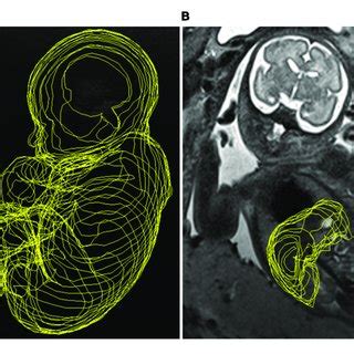 MRI picture of lissencephaly. | Download Scientific Diagram