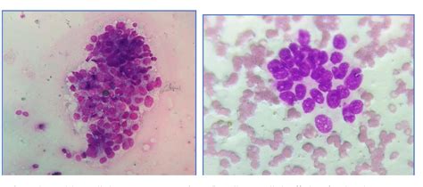 [PDF] A Cytological Study to Differentiate Between Reactive Mesothelial ...